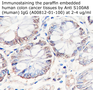 anti s100a8 antibody enables to stain human colon cancer tissues